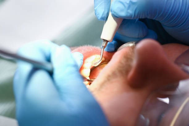 Best Emergency Dentist for Knocked-Out Tooth in Montrose, VA