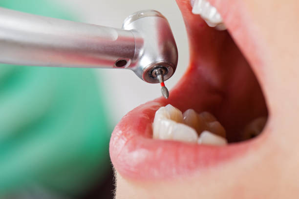 Best Emergency Dentist for Lost Fillings or Crowns in Montrose, VA
